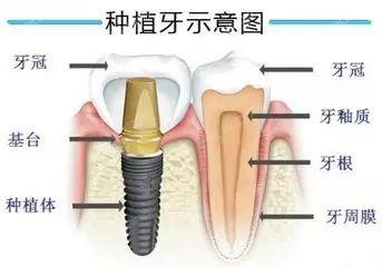 2024杭州种植牙医院排名榜前十揭秘 想找杭州哪里种植牙靠谱技术好看过来