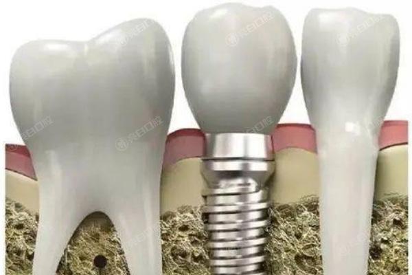 清远瑞士种牙口腔医院排名前十榜单公布！评分高技术靠谱的种植牙排名榜找到了