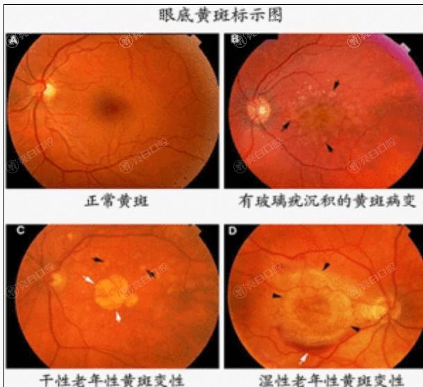 分享杭州朝聚眼科医院眼科项目价格一览表 晶体矫正、全飞秒、飞秒矫正、近视眼部分有折扣
