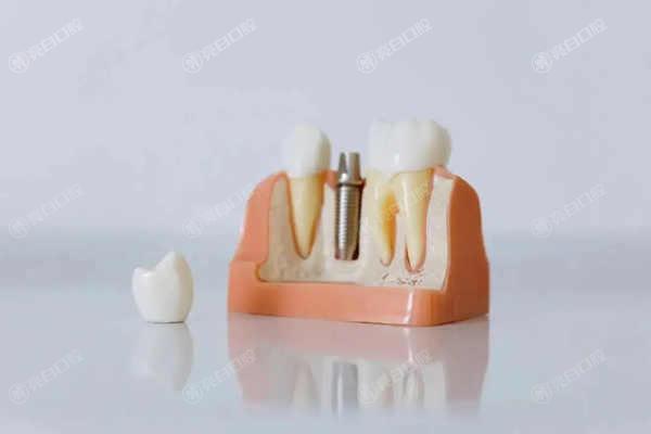 2023种植牙多少钱一颗价格表