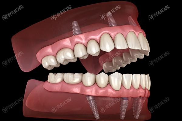 2023全口种植牙一般需要多少钱？