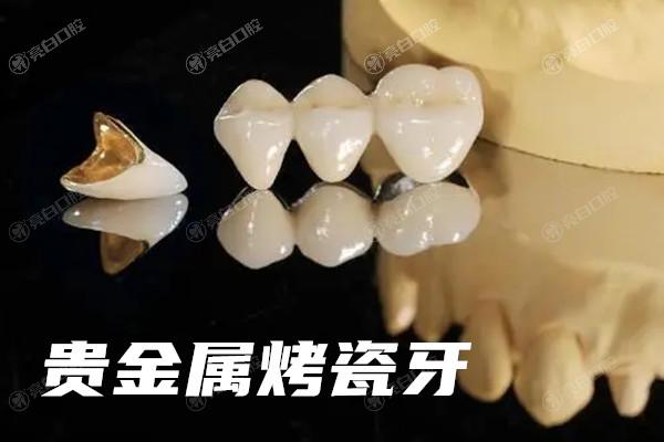 全瓷牙和烤瓷牙有什么区别