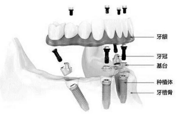 天津种植牙多少钱2023年价格表,查询一颗/半口/全口种植牙多少钱