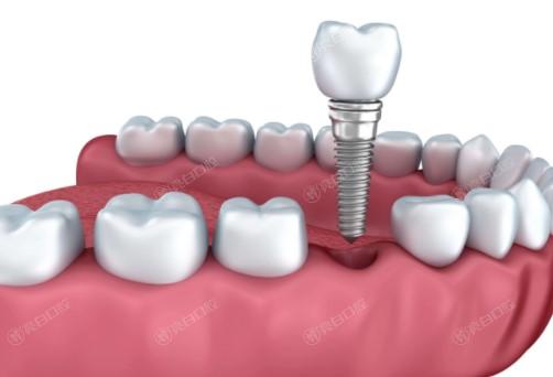 国内种植牙多少钱一颗2023年