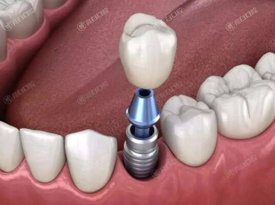 牙博士口腔医院收费标准2024,种植牙2800牙齿矫正6800补牙220不贵