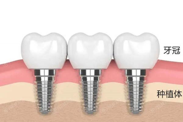 杭州种植牙收费价格表