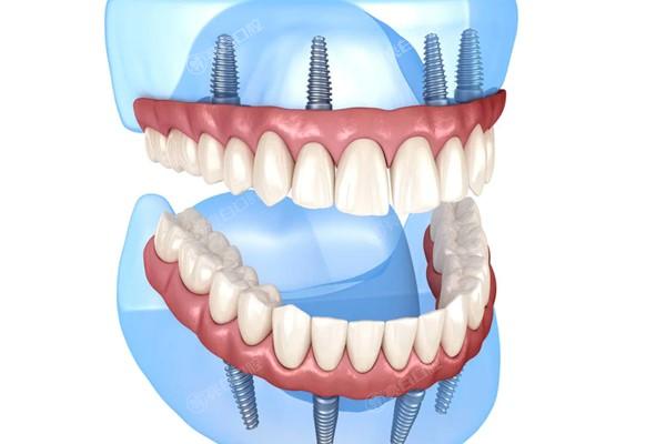 全口种植牙