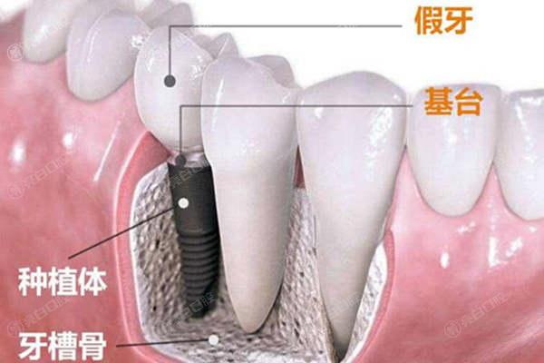 南京口腔医院种植牙价格表2023