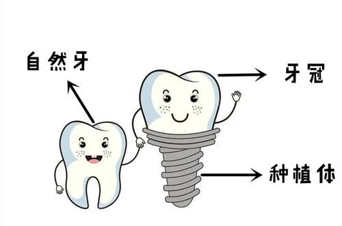 南京口腔医院种植牙多少钱一颗