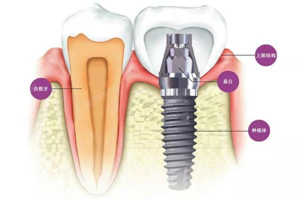 种植体结构