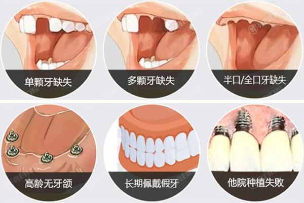 哪些情况需要种植牙
