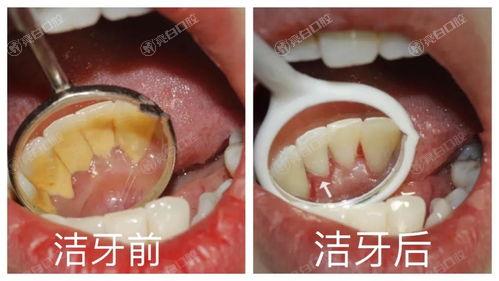 深圳洗牙医院排名,以下三家医院洗牙比较好价格优惠