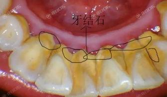 北京2025洗牙六大口腔医院排名，这六家牙科正规口碑好值得推荐