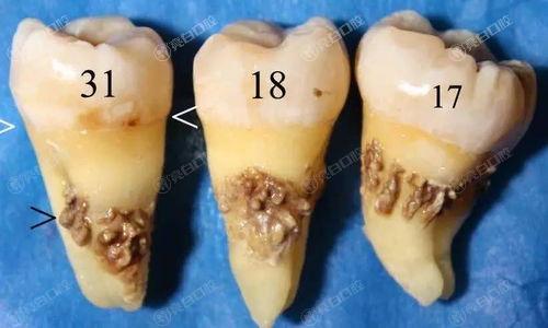 北京洗牙哪家医院好？靠谱价格好的六大牙科医院投递