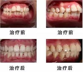 北京牙齿矫正哪家医院好？曝靠谱实力好的牙齿矫正前十口腔医院