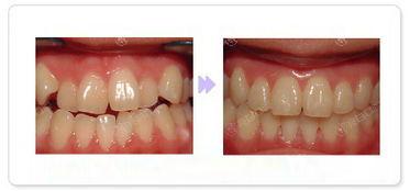 想知道天津牙齒矯正收費多少錢天津牙齒矯正價格超實惠