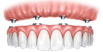 2024年三门峡种植牙医院排名前五曝光，告诉你哪家种植牙靠谱服务好