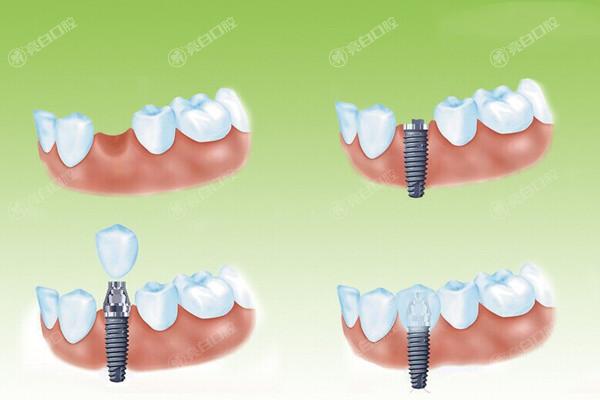 种植牙过程