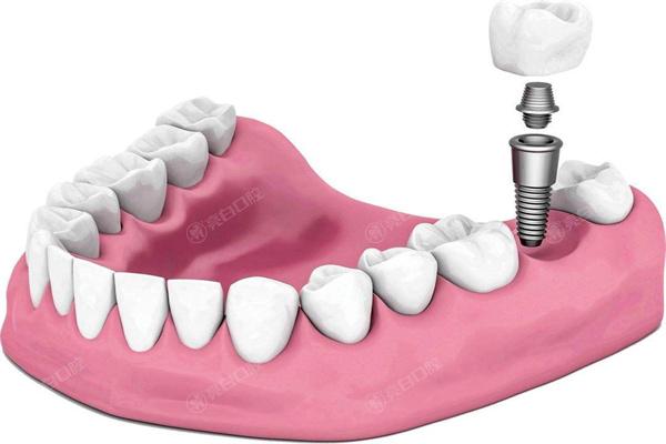种植牙收费价格表