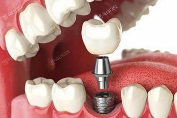 淮北瑞士种牙好的口腔医院是哪家？曝靠谱技术好的种植牙前三口腔医院