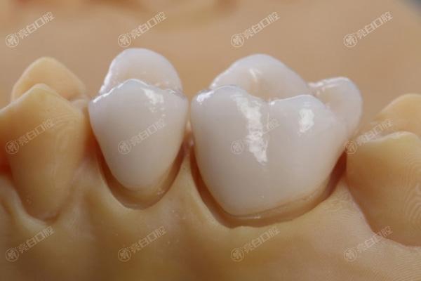 合肥全瓷牙牙科医院排名榜公布！看合肥哪家全瓷牙好服务靠谱