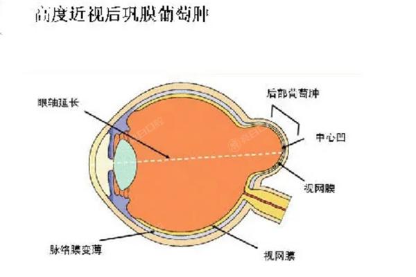 王乐今做后巩膜加固手术怎么样?患者评价技术好价格2w+提供预约方式