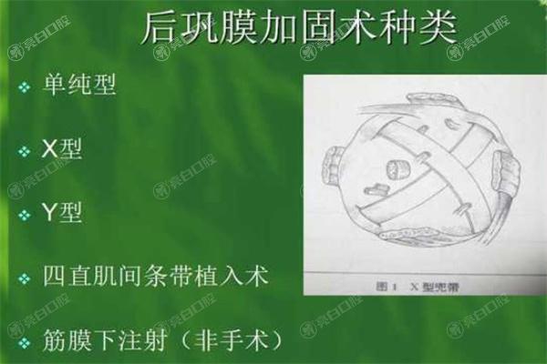 王乐今做后巩膜加固手术怎么样?患者评价技术好价格2w+提供预约方式