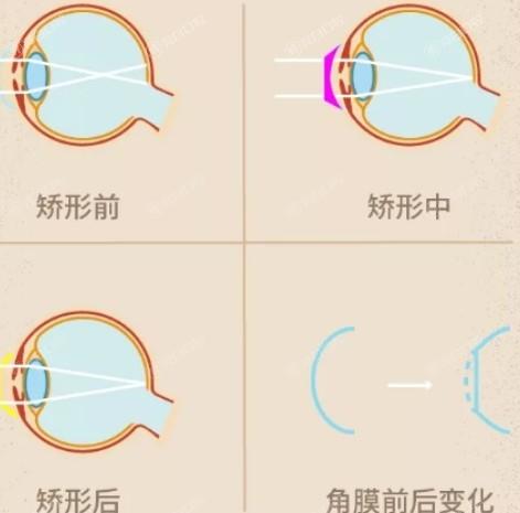 一览南京眼科医院白内障手术收费标准一览 其中双焦点晶体16800元+|单焦点晶体15900元+|可调节晶体19500元+