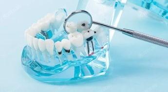 揭晓河南郑州上工口腔口腔项目收费标准一览 洗牙/补牙/种牙/半口种植牙费用不贵
